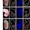 يُظهر هذا الشكل خلايا الكلى المتوافقة مع البشر (باللون الأحمر) داخل الجنين مقارنة بجنين خنزير من النوع البري